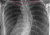A little too curvy? Free scoliosis screening & lecture