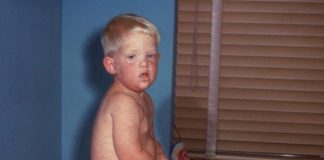 Measles outbreak, measles vaccines, measles in Arizona